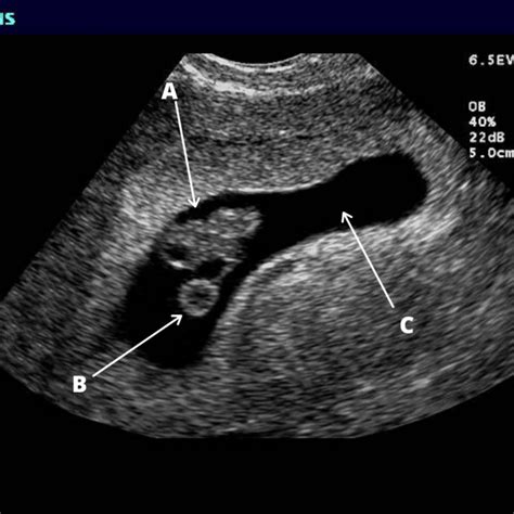 fetal pole dating scan